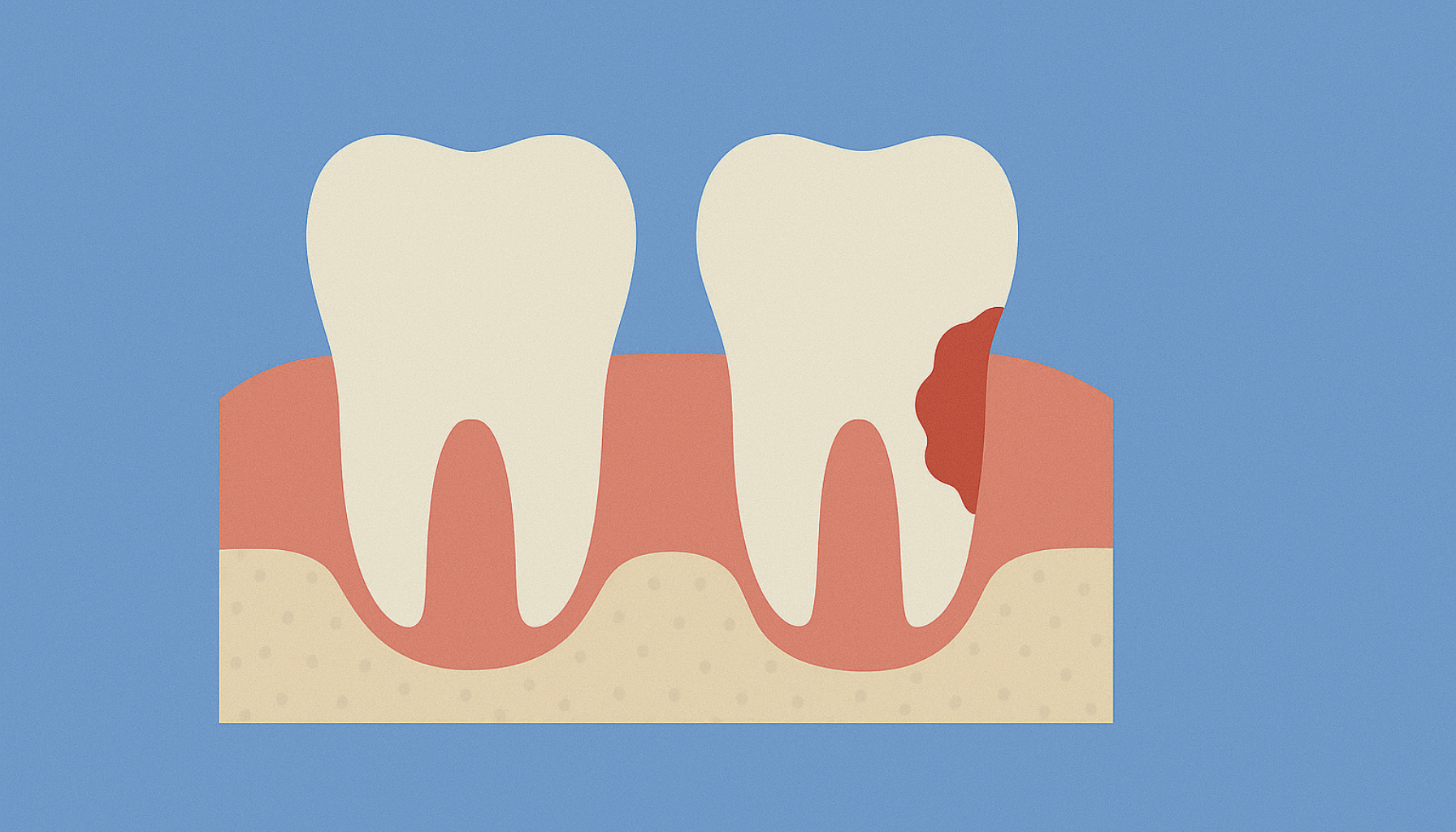 Resorpsjon av tann – en skjult fare du bør kjenne til