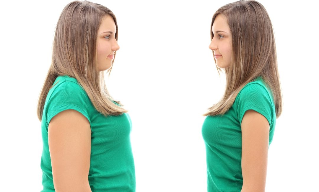 gastric bypass surgery