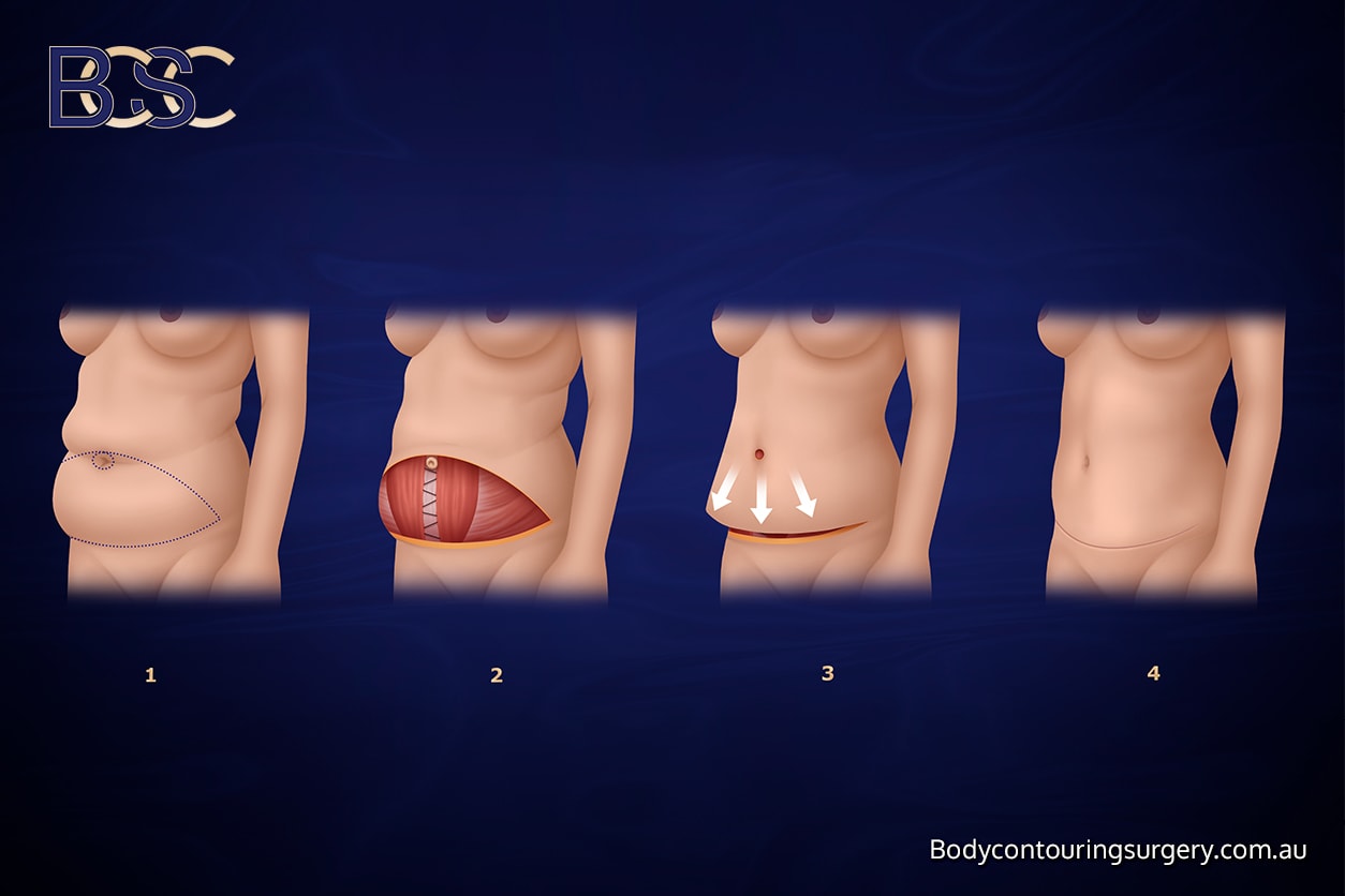 Standard abdominoplasty Standard abdominoplasty