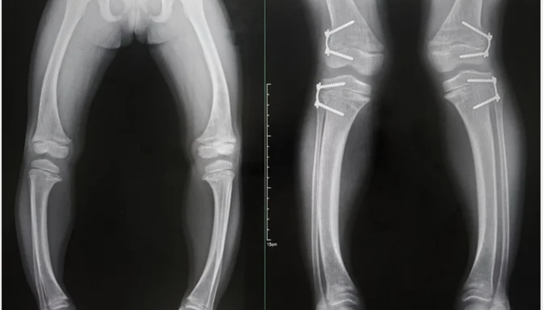Rakitt: Den glemte sykdommen som fortsatt finnes 9 Røntgen av ben med rakitt som viser bøyde knokler og kirurgiske skruer for korreksjon."