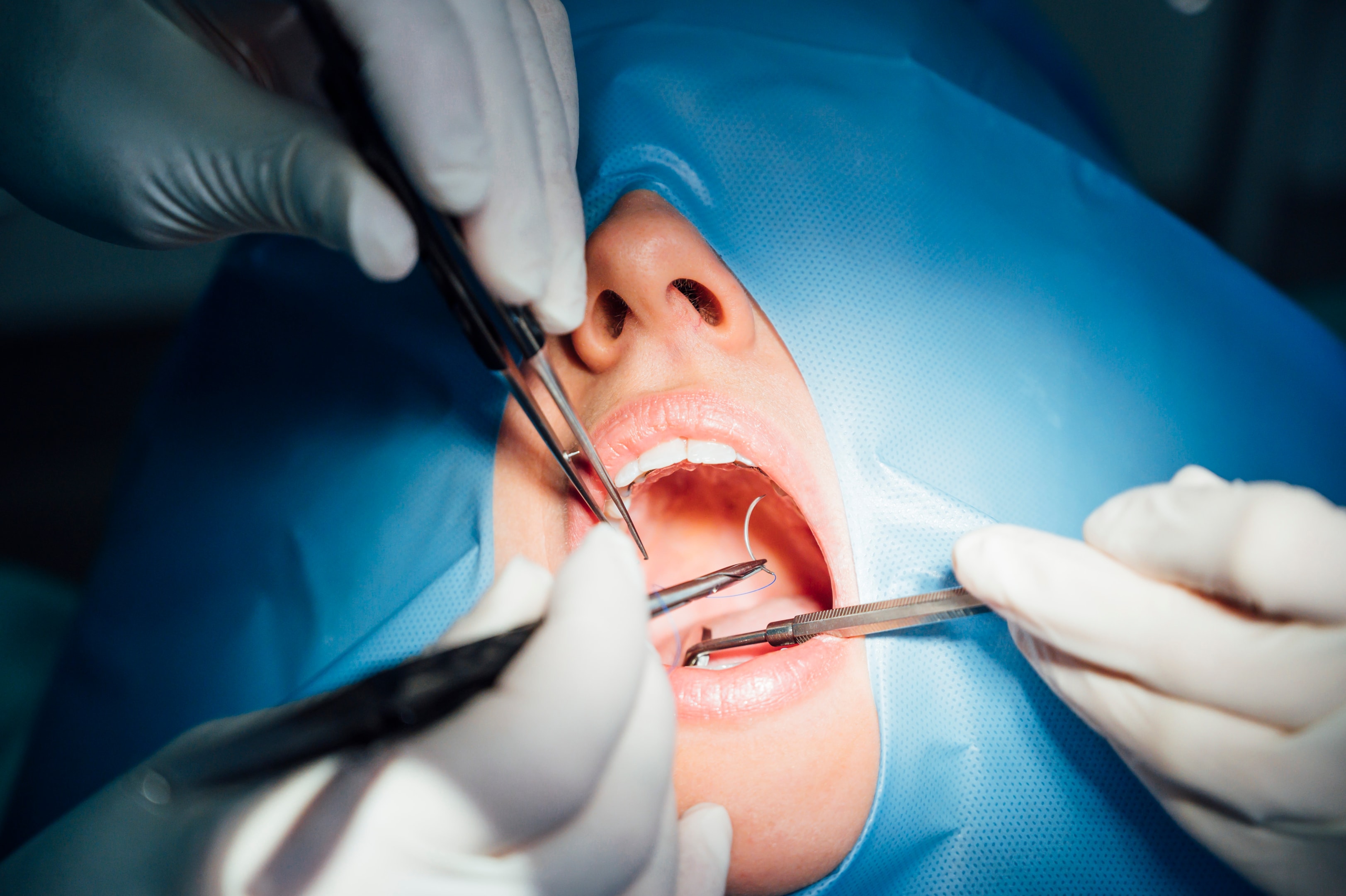 Person getting wisdom tooth extraction procedure