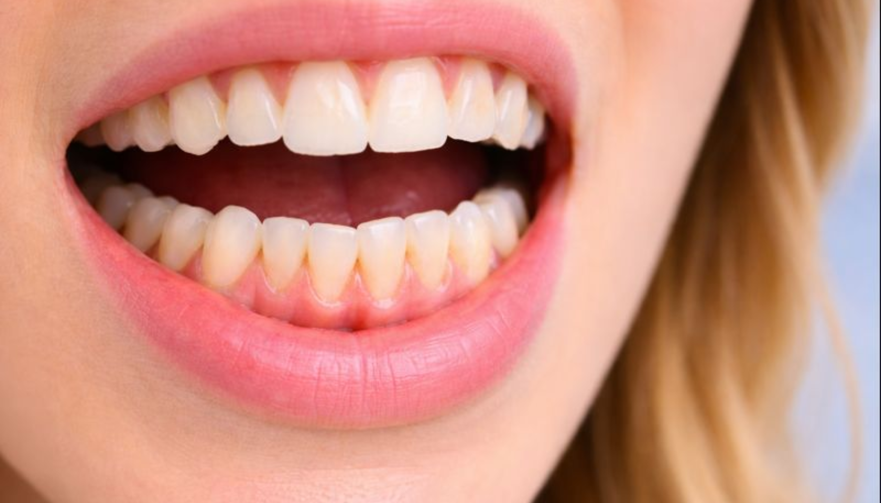 Gom Tenner: Når Tennene Ikke Møtes Som De Skal 12 Åpen munn viser tannskjevhet og overbitt med trangstilling i underkjeven, fokus på tenner og bittavvik.