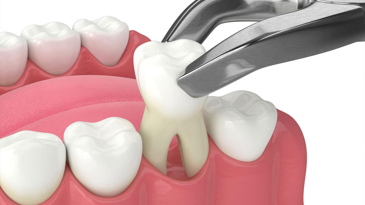 Image showing a tooth removal