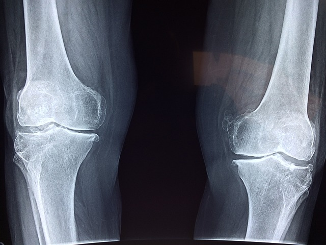 x-ray for knee replacement