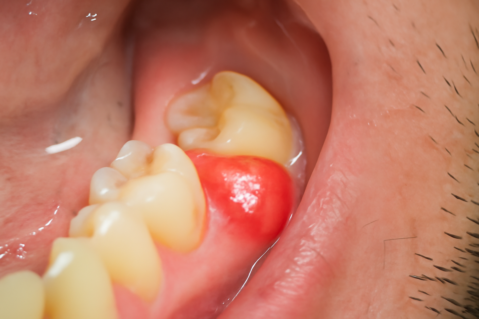 Nærbilde av nedslitte fortenner undersøkt med tannlegeverktøy for behandling og forebygging av tannslitasje. attrisjon tap av tannsubstans tannslitasje erosjon tennene tenner behandling patologisk hos slitasjen slitasje tap tanngnissing tannsubstans faktorer ofte tid sykdom behandlingen skader sure resultat funksjon slites andre problemer