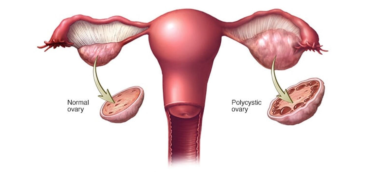 What Is PCOD and Can the Right Diet Actually Cure It?