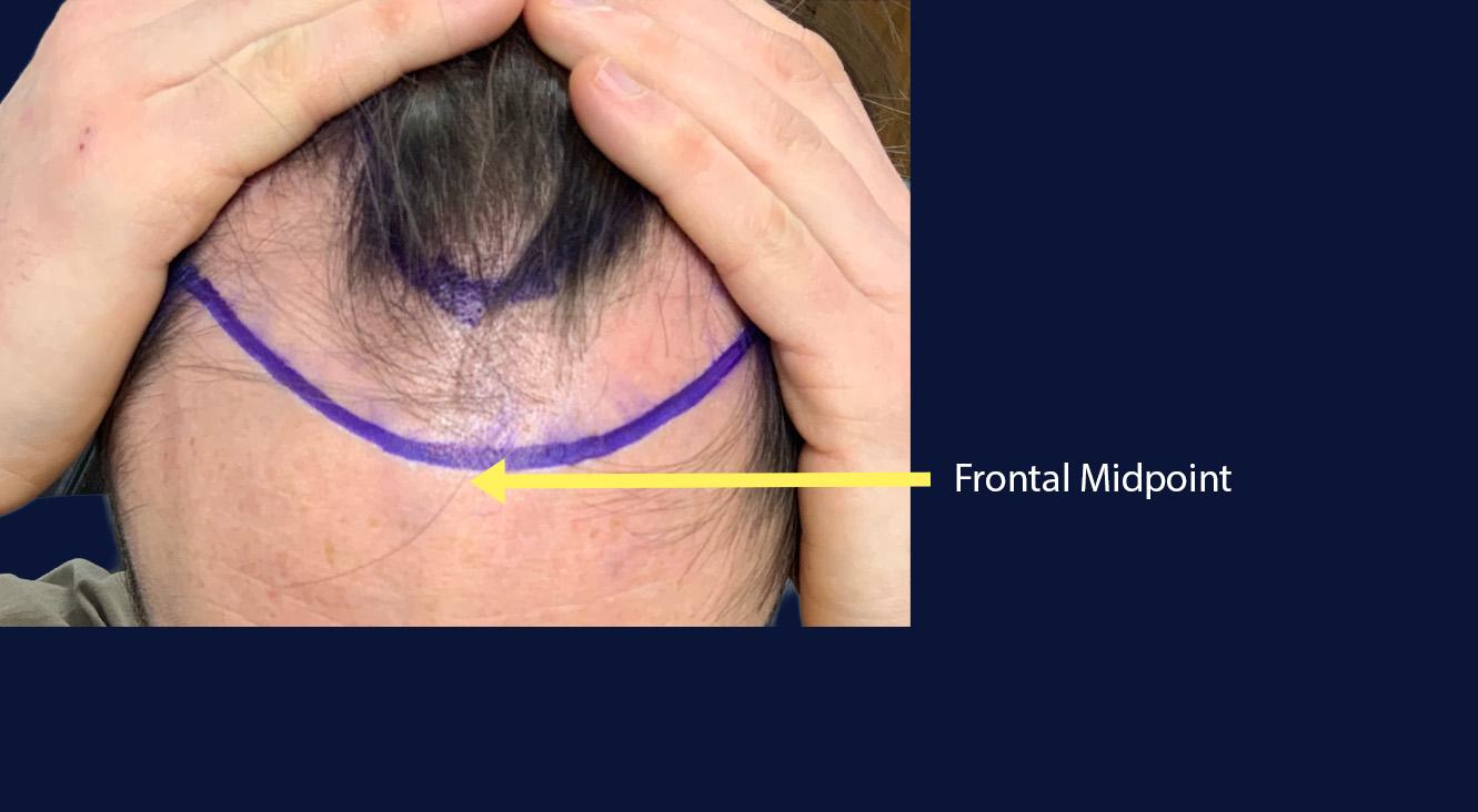 Dr Kunnure Clinic- Hair Transplant - Hairline