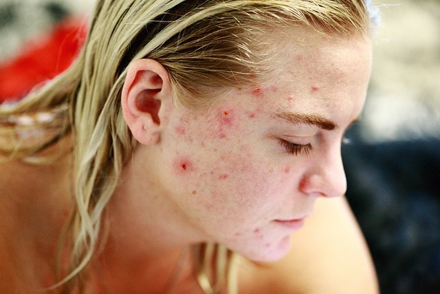 Microneedling wie oft? Alles, was Sie wissen müssen über die optimale Anwendung 2 5342d0f9 8534 45b6 b249 593cf279193f