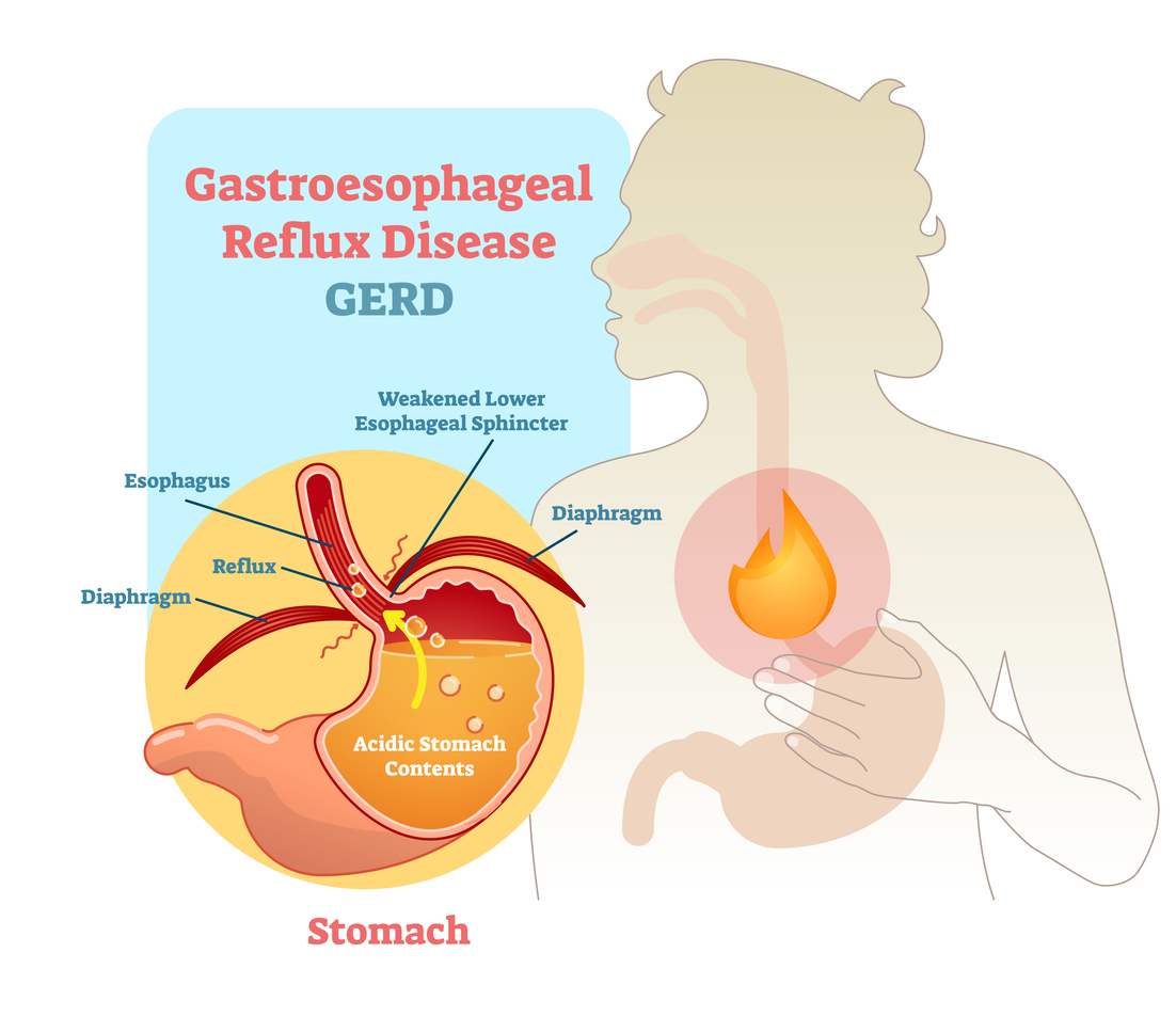 An image of a diagram of illustrating how stomach acid flows back to the esophagus with explanatory text described below.