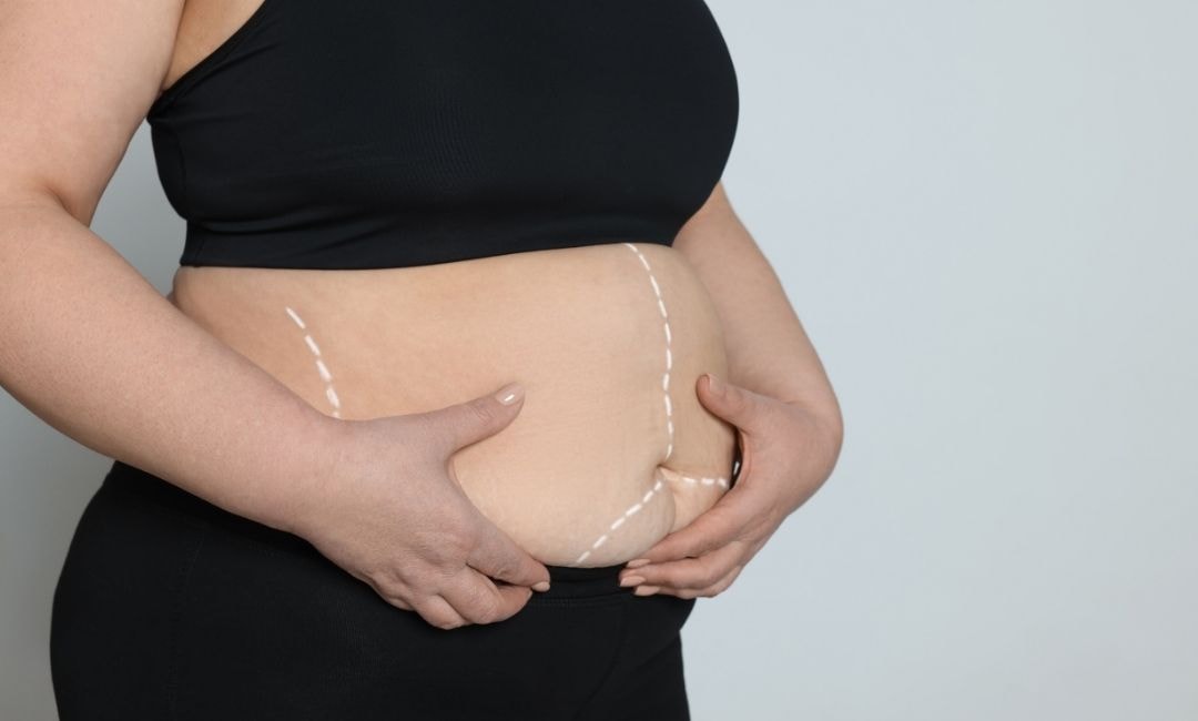 Bariatric Surgeries