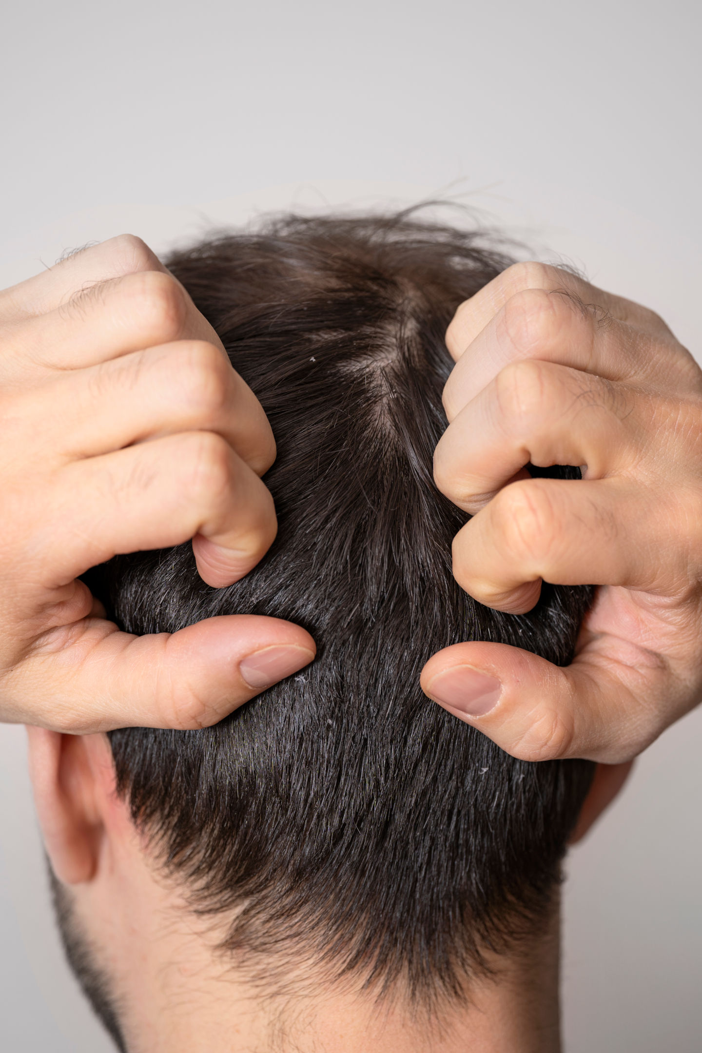 Ketoconazole helps relieve the scalp itching caused by fungal infections.