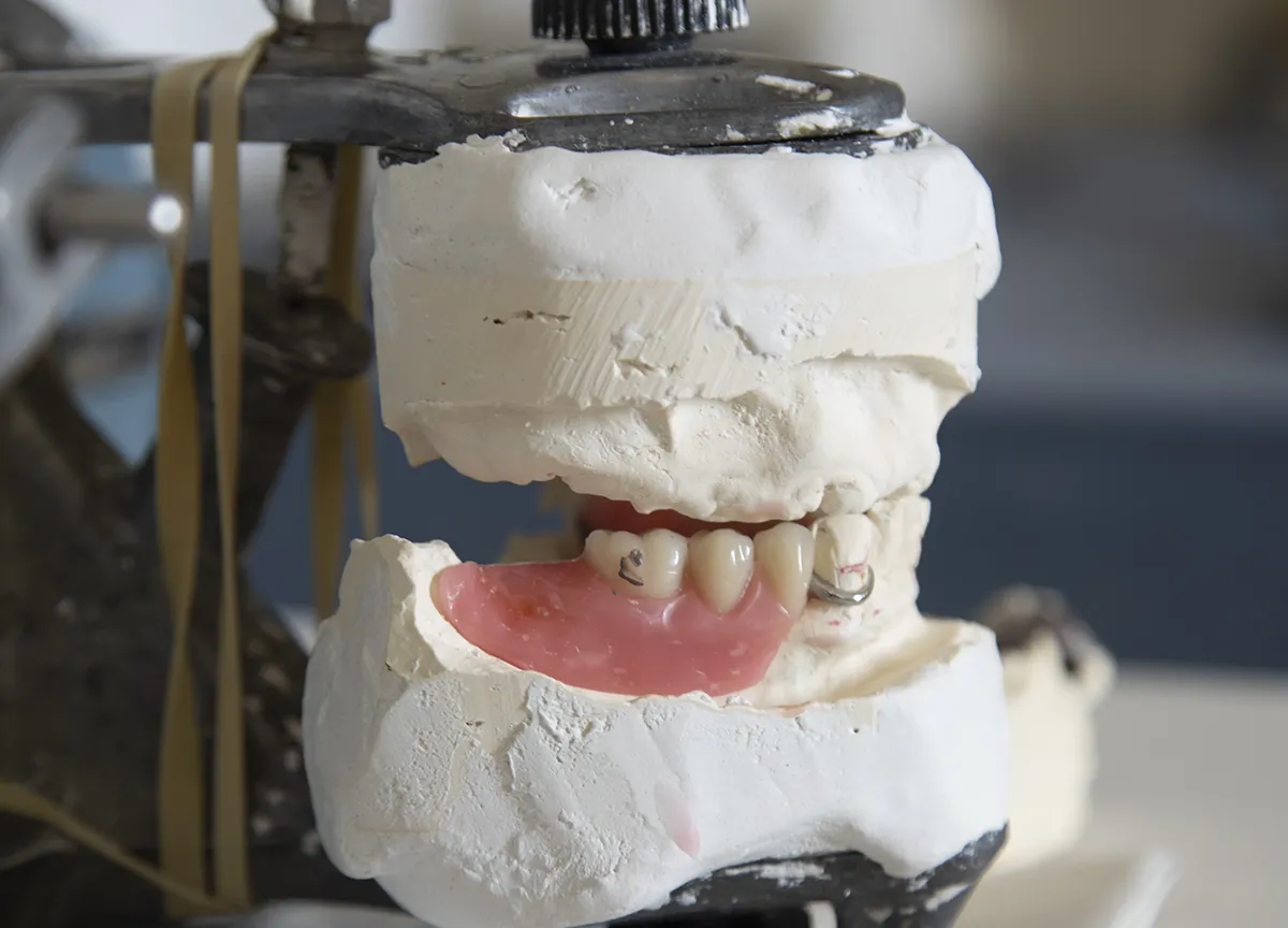 Dental model with partial denture mounted on articulator showing teeth