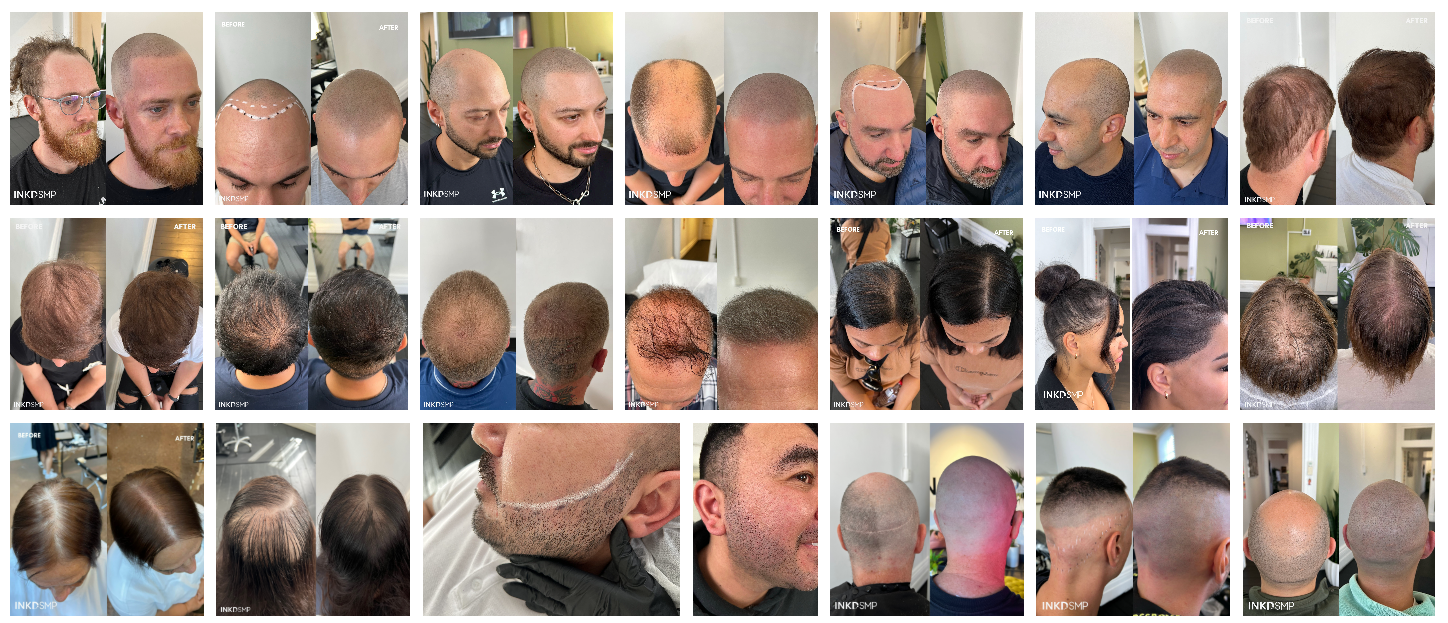 Scalp micropigmentation before and after examples at INKD SMP