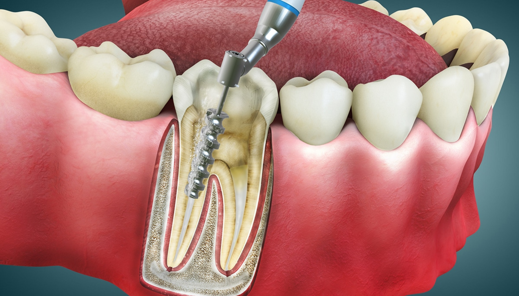 Illustrasjon av rotfyllingsbehandling hvor tannlegeverktøy fjerner betennelse fra tannens rotkanaler under tannkjøttet.