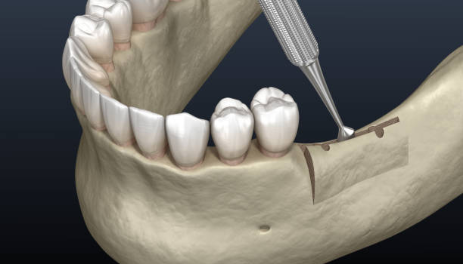 3D-illustrasjon av kirurgisk inngrep i underkjeven, der tannlegeinstrument brukes for å løfte benstruktur nær tennene i forberedelse til behandling.