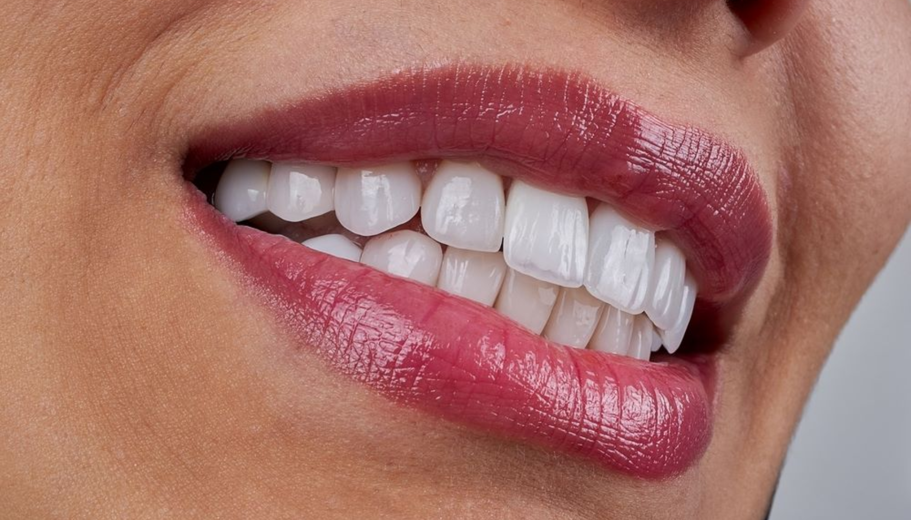 «Nærbilde av kvinne med rød leppestift og hvite tenner som smiler bredt.» composite resin bonding bonding is is a to the bonding the quick and and composite dental quick resin tooth how material dine invasive time plus surface kompositt best light brukes våre special bruk