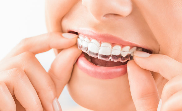 invisalign provider, invisalign work