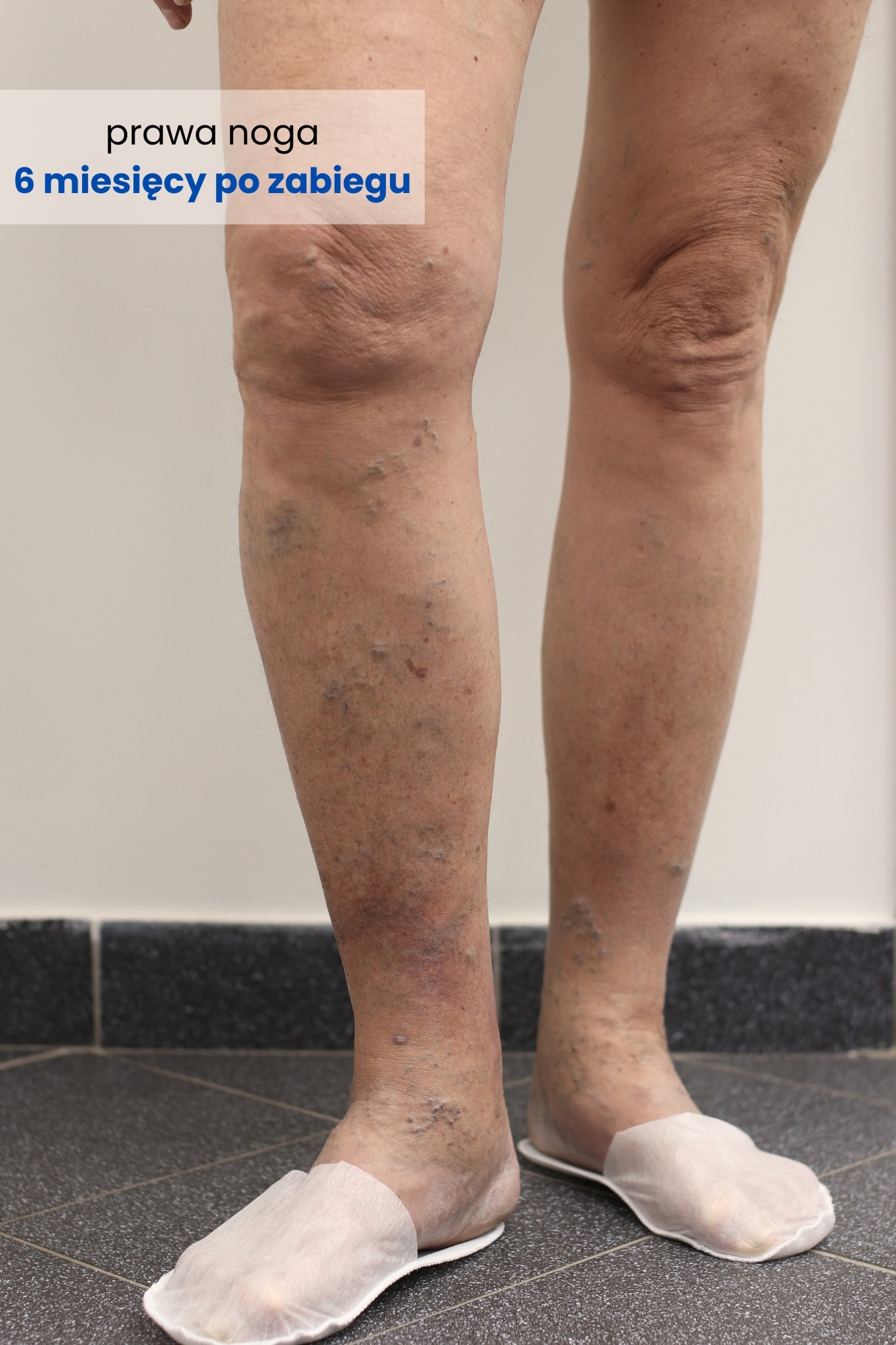 Zdjęcie prawej nogi Pacjenta 6 miesięcy po zabiegu skleroterapii - efekt