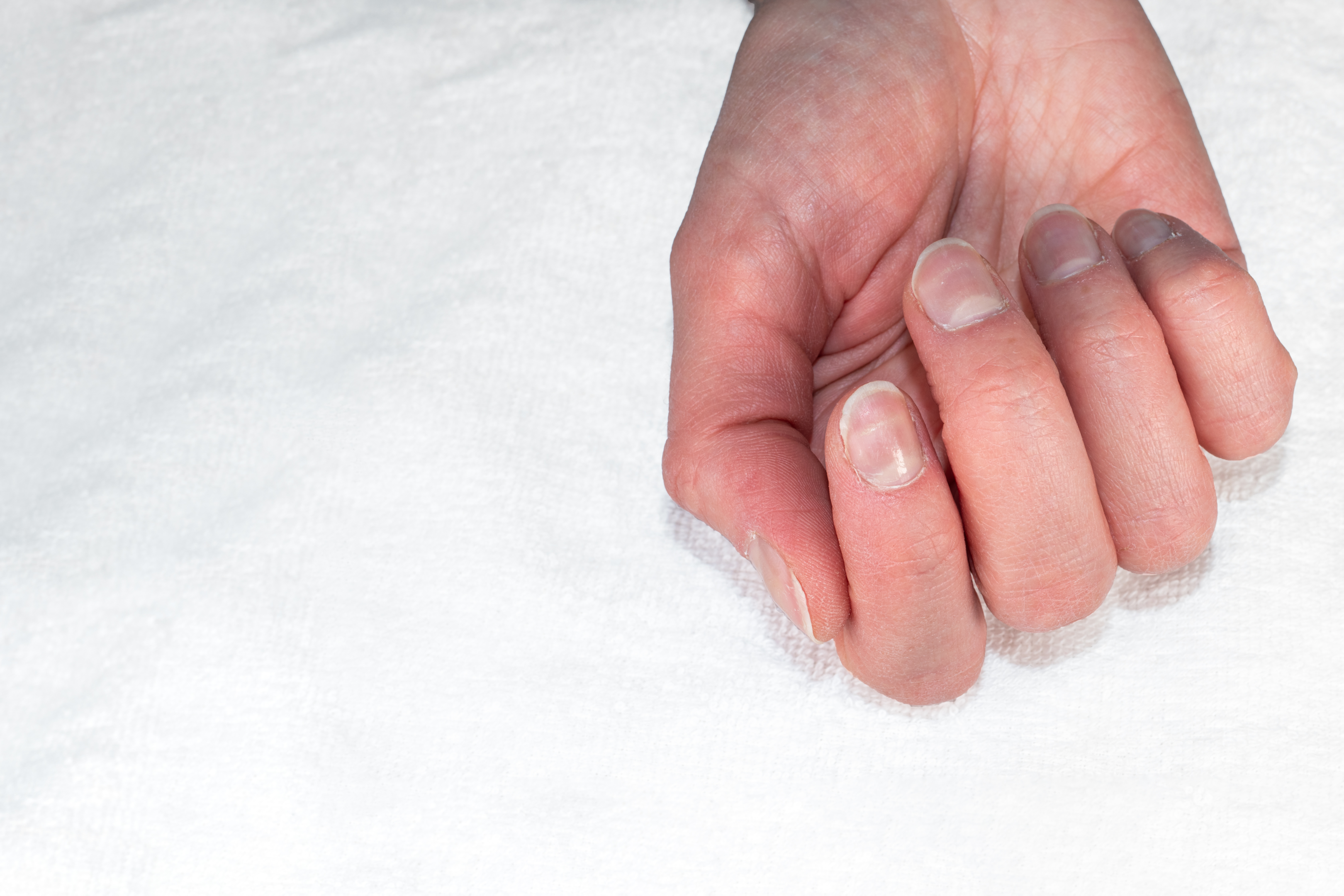 14 Common Health Problems Related to Fingernails – ActiveBeat – Your Daily  Dose of Health Headlines