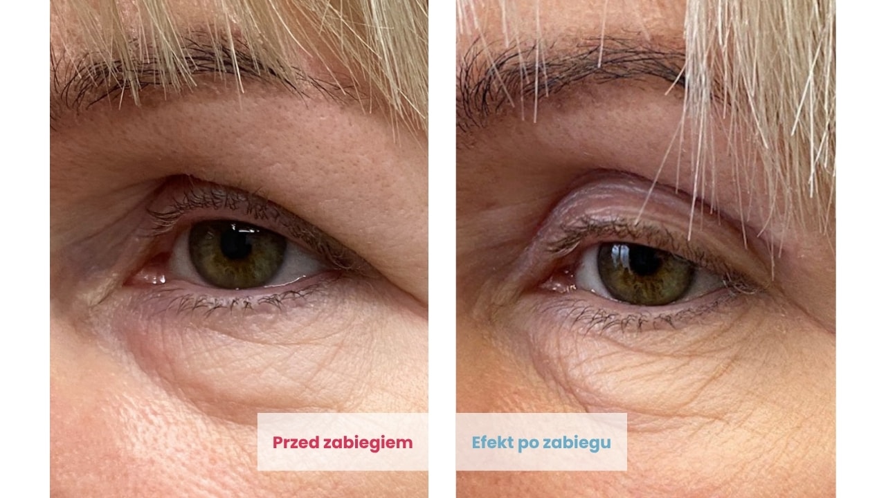 Efekty plastyki powiek górnych u Pacjentki kobiety