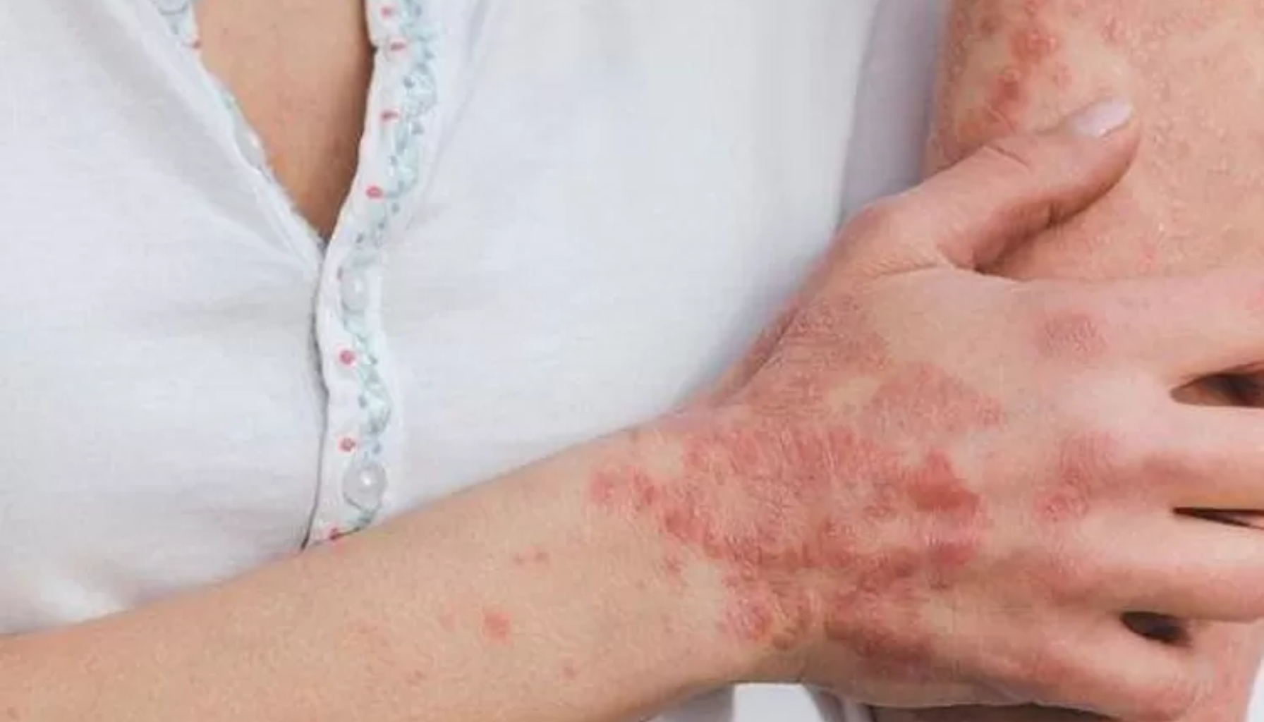 Person med rødt, kløende utslett og betente flekker på hånd og underarm, trolig hudirritasjon eller eksem. stevenson syndrom stevens johnson syndrom toksisk epidermal nekrolyse toksisk epidermal nekrolyse ten stevens johnson syndrome and and toxic epidermal necrolysis syndrome and toxic epidermal johnson syndrome and toxic toxic epidermal necrolysis stevens johnson syndrom sjs stevens johnsons syndrom sjs og toksisk sjs og toksisk epidermal erythema multiforme herpes simplex virus hud og slimhinner alvorlig tilstand syndrom økt risiko per år sjs ten behandling symptomer huden tilfeller hud tilstanden slimhinner nsaids sår infeksjoner ofte infeksjon risiko feber alvorlig blemmer utslett bruk tilstand assosiert kroppen sjelden utløsende per andre rammet mens kjent sykdommen hos mer første økt søk pasienter helsepersonell uker medikamenter behandlingen personer spesielt blant legemidler væske legemiddel prognose livstruende utslettet flere sykdom øyne oftest fører mindre nesten antibiotika munn reaksjon regnes