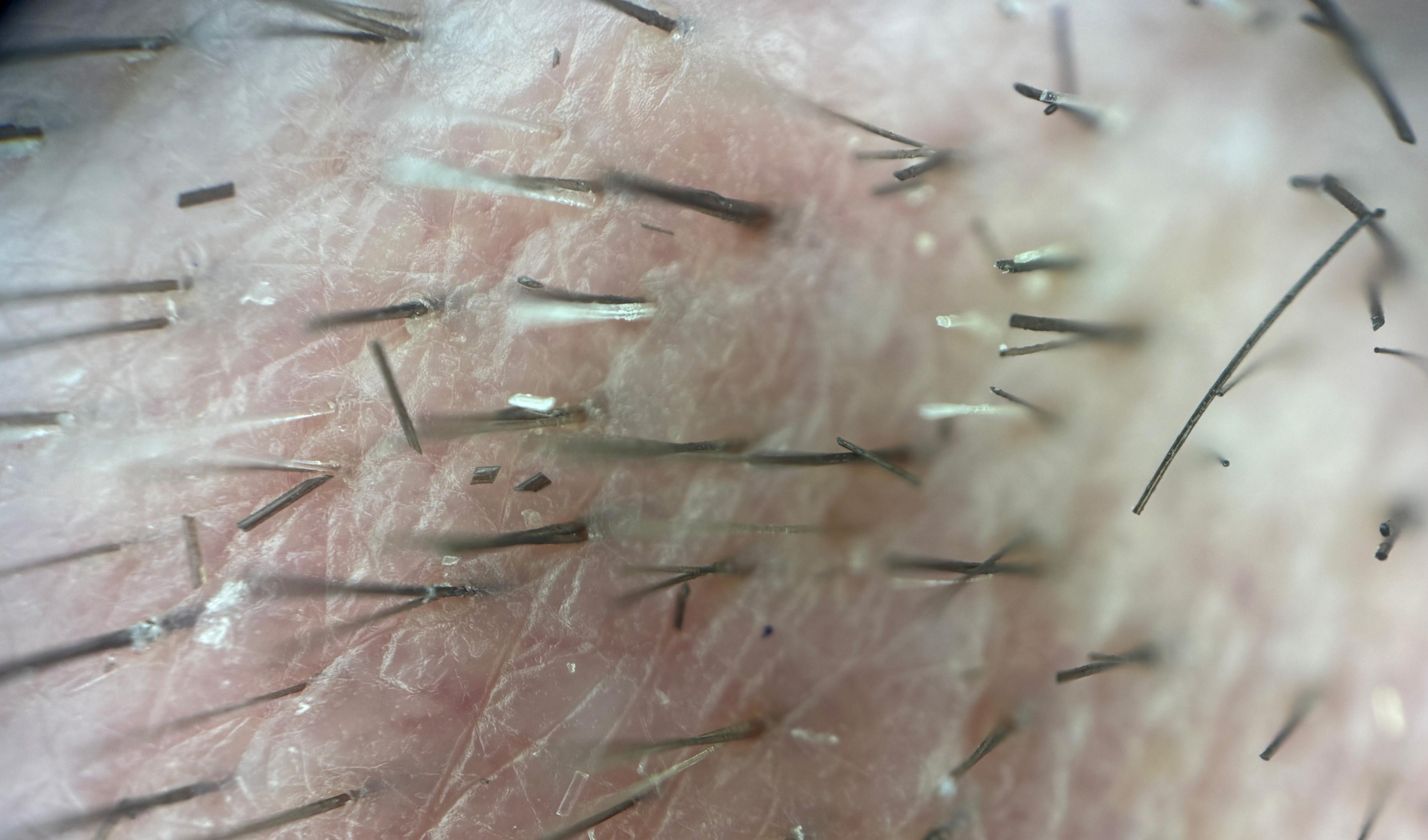 Dr Kunnure Clinic - Hair Transplant - Low donor Density