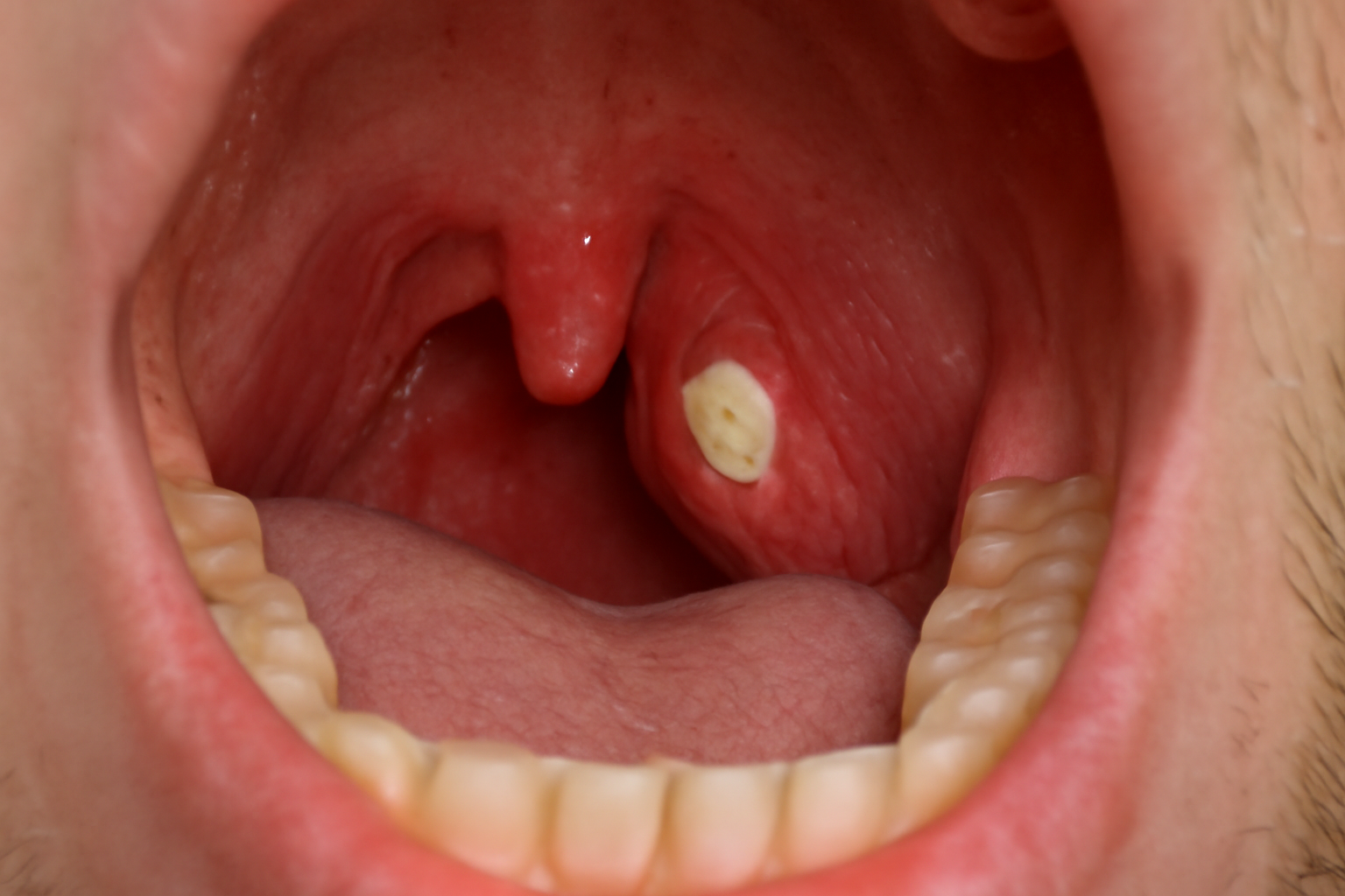 Nærbilde av mandelstein i halsen, viser en hvit klump i venstre mandel, omgitt av rød, betent vev." spondylitt ankyloserende spondylitt hla b27 aksial spondyloartritt betennelse i ledd ulcerøs kolitt reaktiv artritt smerter og stivhet fysisk aktivitet hos barn biologisk behandling andre ledd sist oppdatert inflammatorisk tarmsykdom hos menn sykdom spondyloartritt hos ledd behandling andre betennelse ofte symptomer bør smerter sykdommen viktig effekt artritt stivhet får aksial dmards forandringer ryggsmerter behandlingen gir dersom ryggraden mens røntgen fysisk bruker mer inflammatorisk flere undersøkelse barn risiko nsaids aktivitet vanligvis diagnosen aktiv psoriasis medisiner trening ryggen vanlig tillegg uveitt bevegelighet rygg enkelte fysioterapi god diagnose første undersøkelser tnf funksjon høy regelmessig kronisk særlig disease leddene hofter legemidler