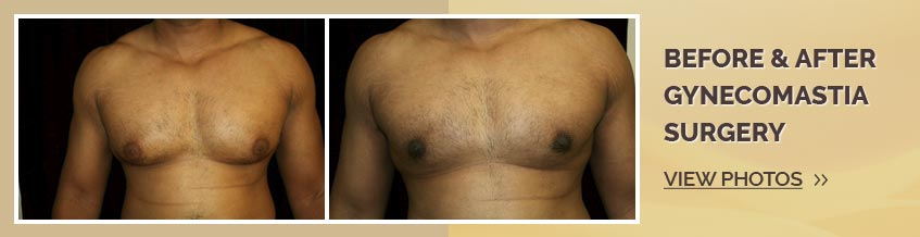                                                                  Before and after gynecomastia surgery