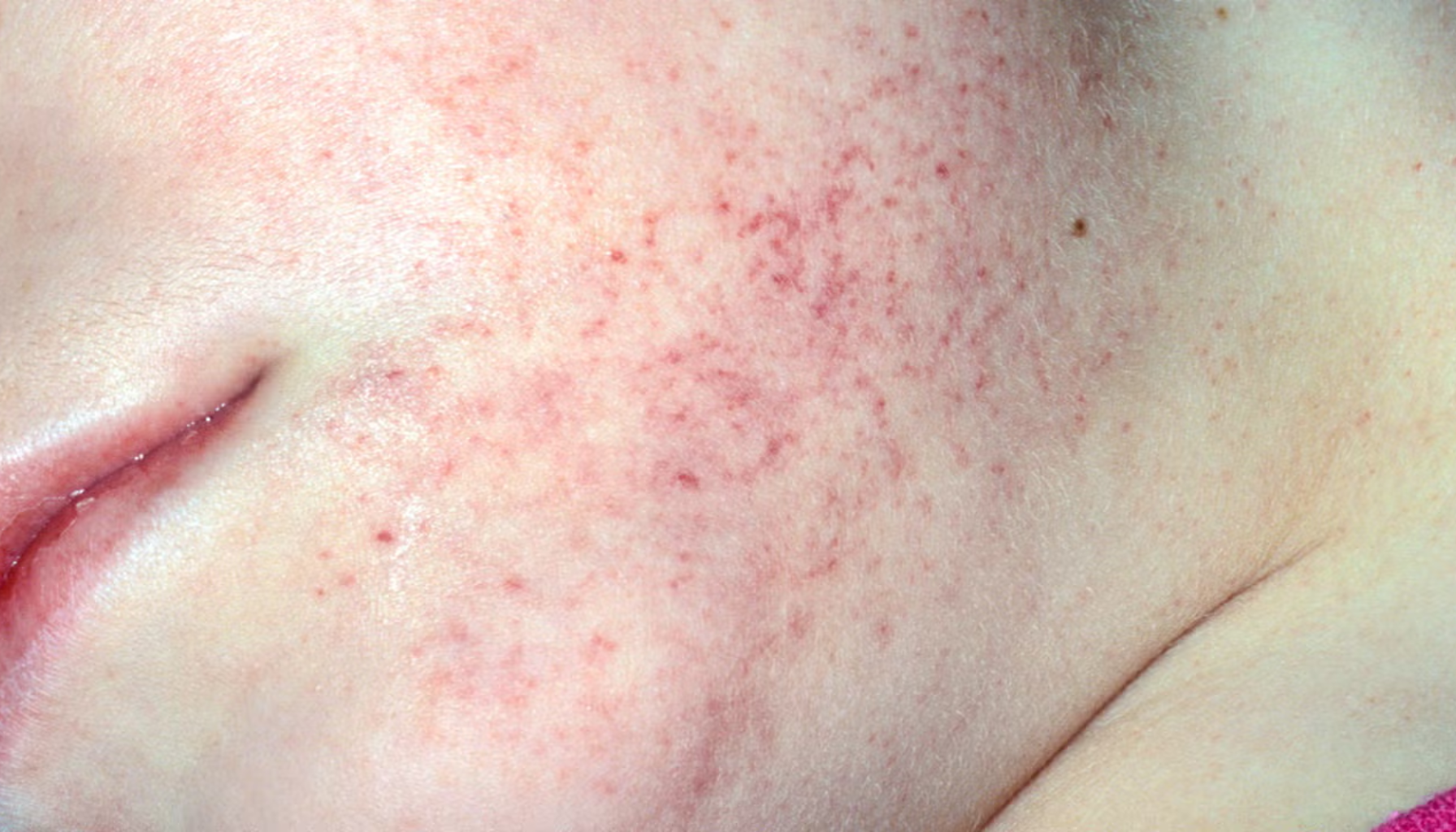 Røde prikker og utslett på kinnet, mulig hudirritasjon eller allergisk reaksjon.