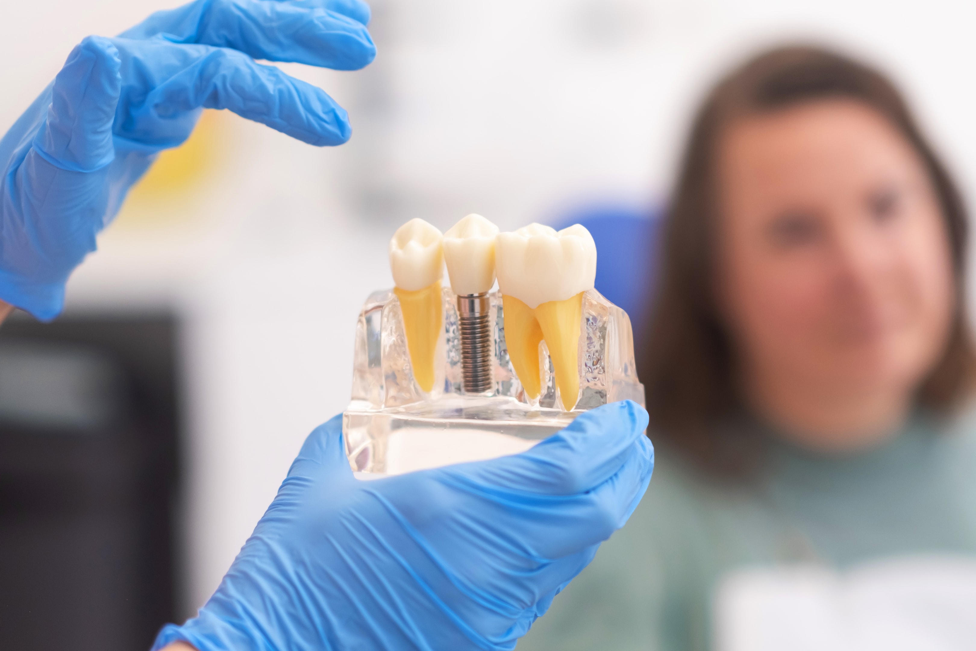 Dental model showing a dental implant with a healing abutment