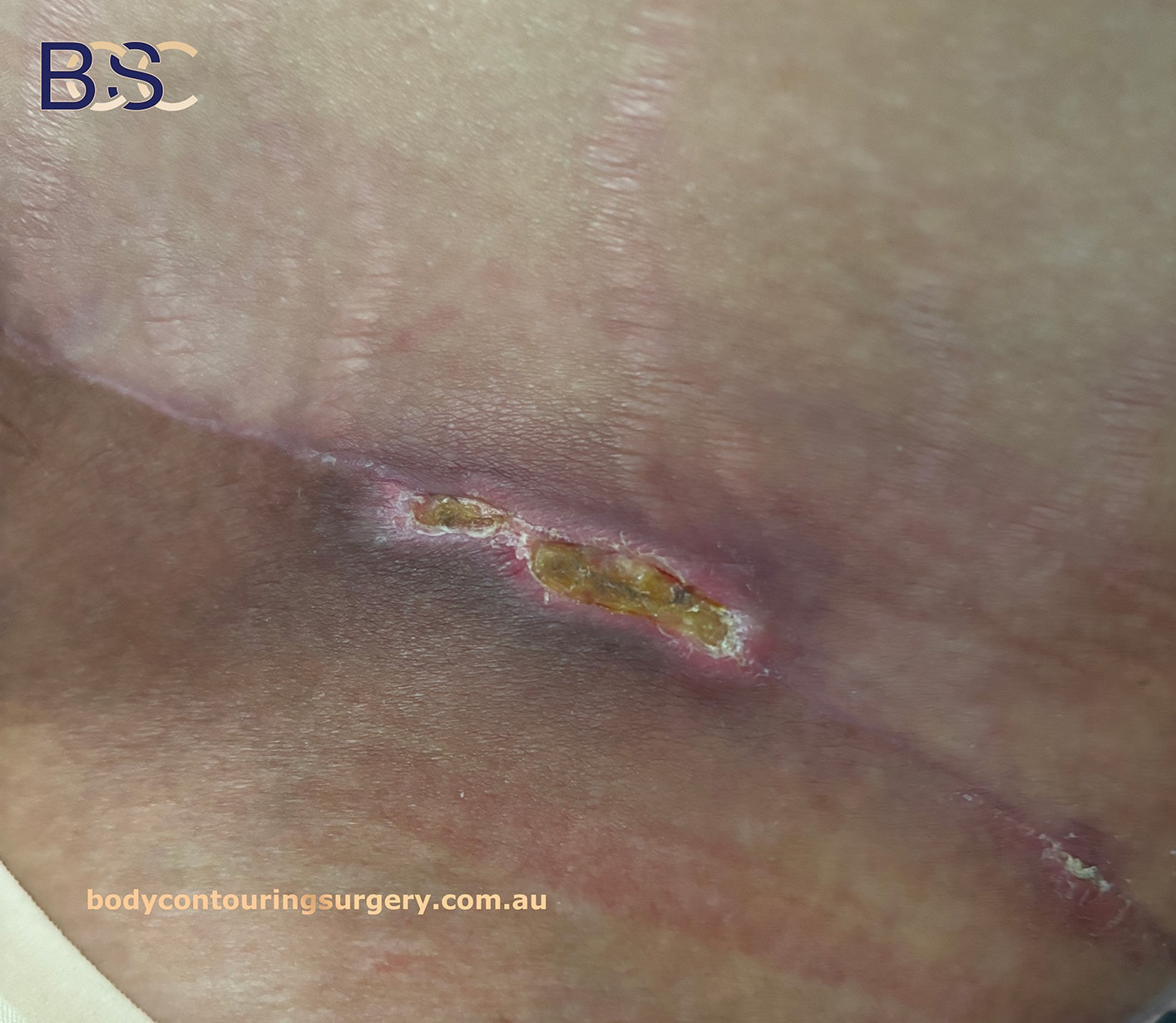 wound separation - Lower Trunk Surgery wound separation - Lower Trunk Surgery