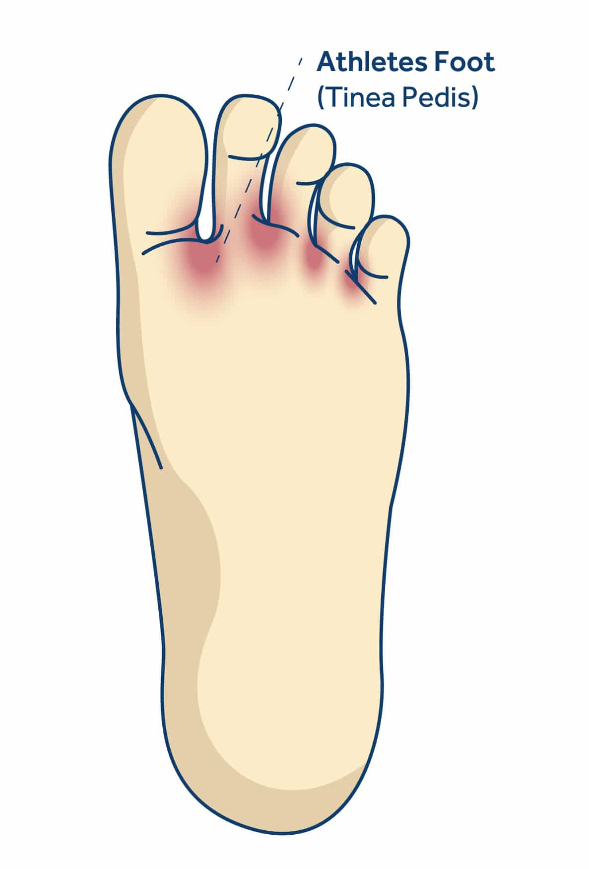 called athlete's foot, athlete's foot contagious, symptoms athlete's foot