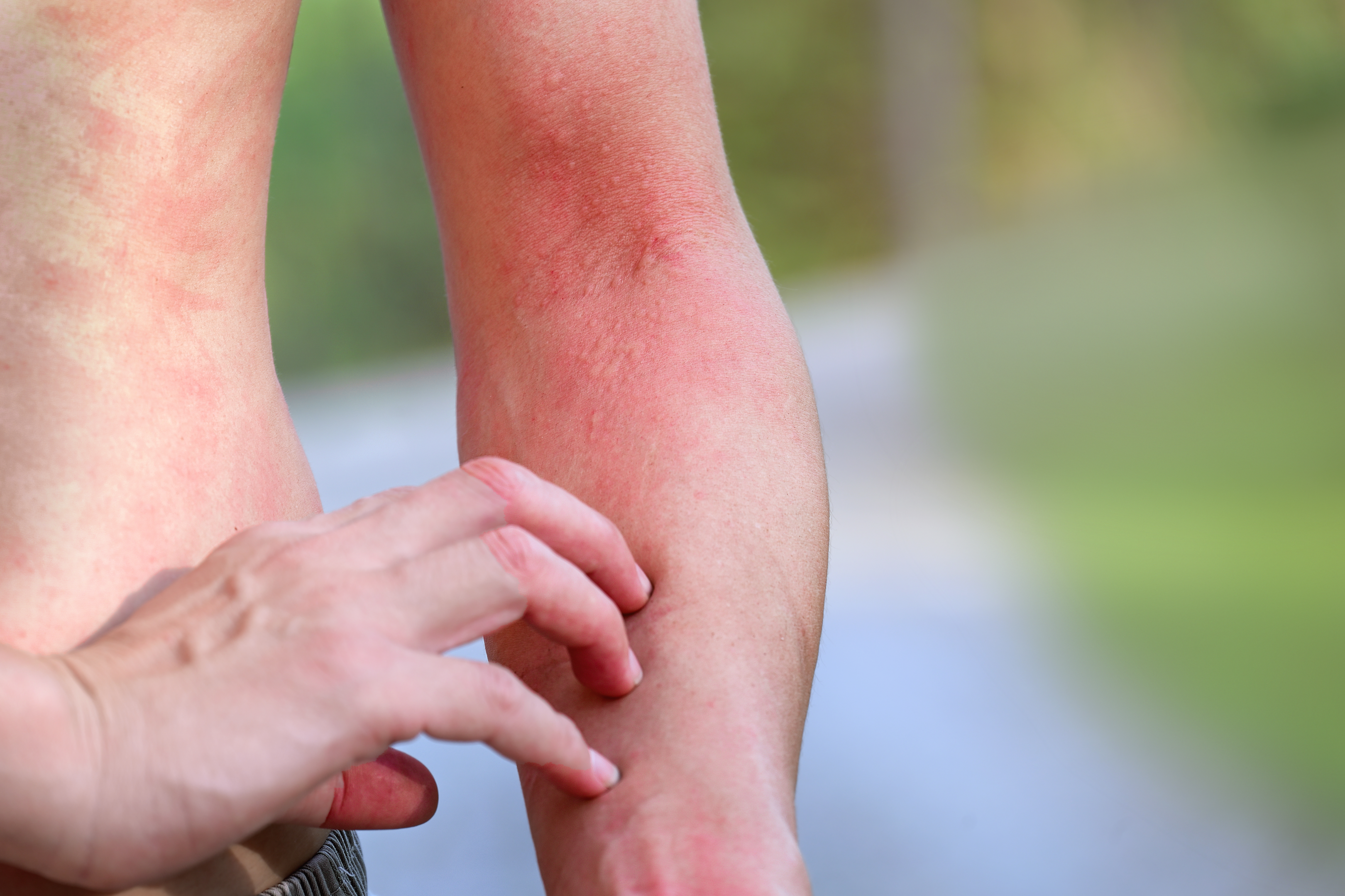 symptoms of heat rash and what to do when a heat rash occurs
