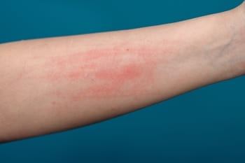 heat rash prickly