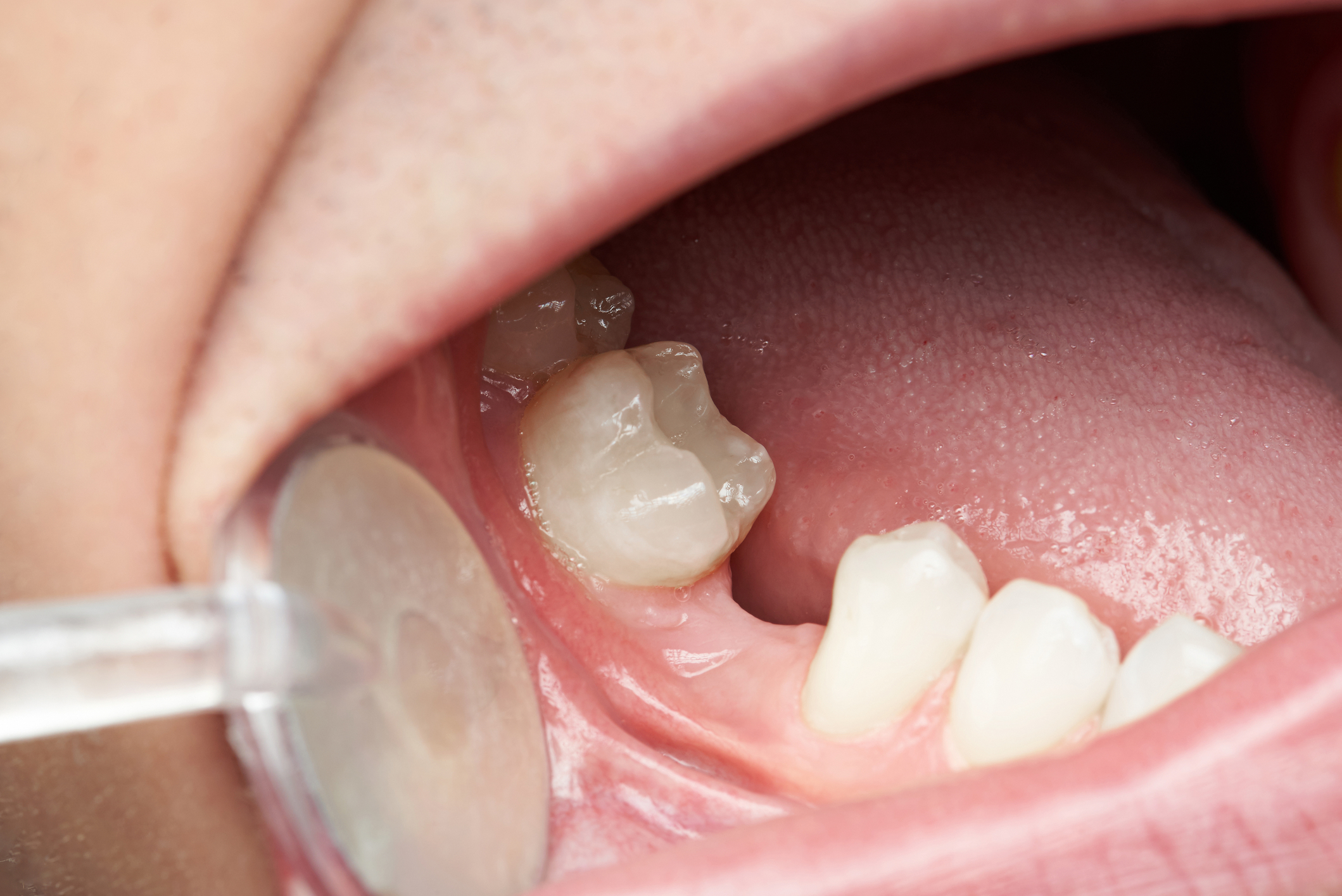 Photo of a gap where dental implants could restore the look of natural teeth