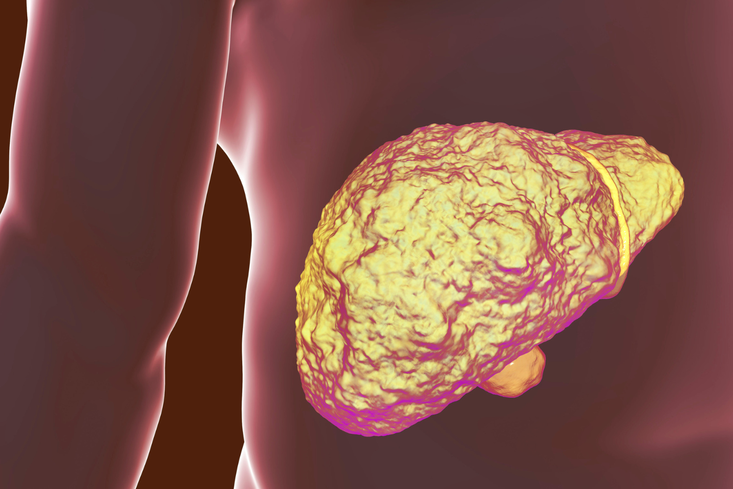Unhealthy liver.