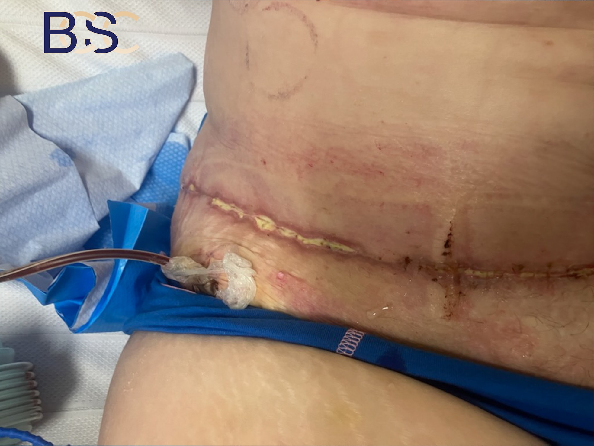 wound breakdown post surgery wound breakdown post surgery