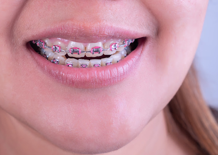 how much do braces cost uk under 18