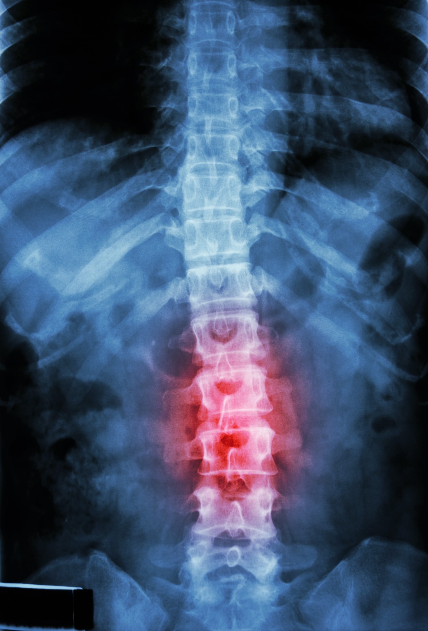 An x-ray of a spine with a red pain point