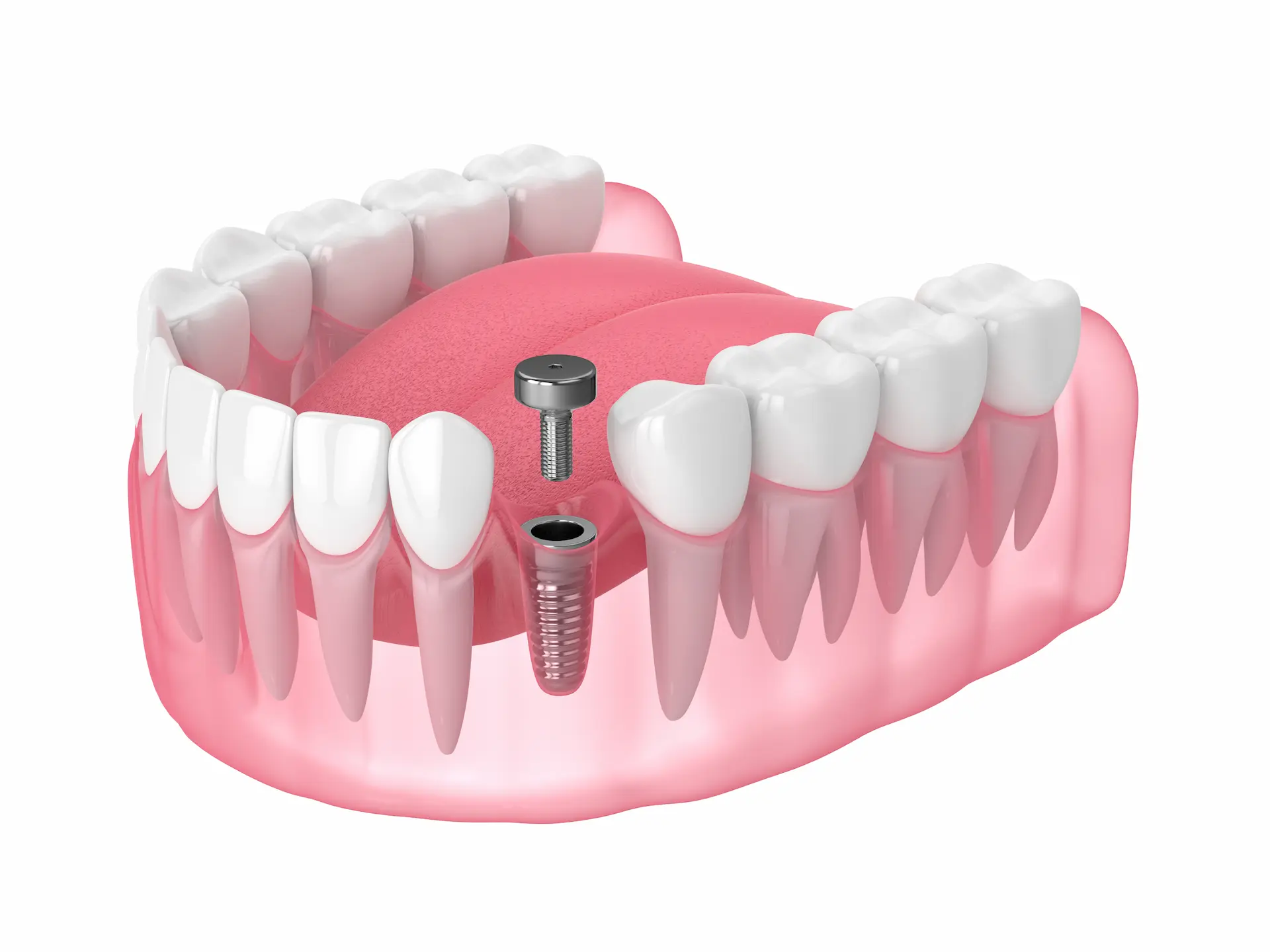 dental model showing where a healing abutment is placed