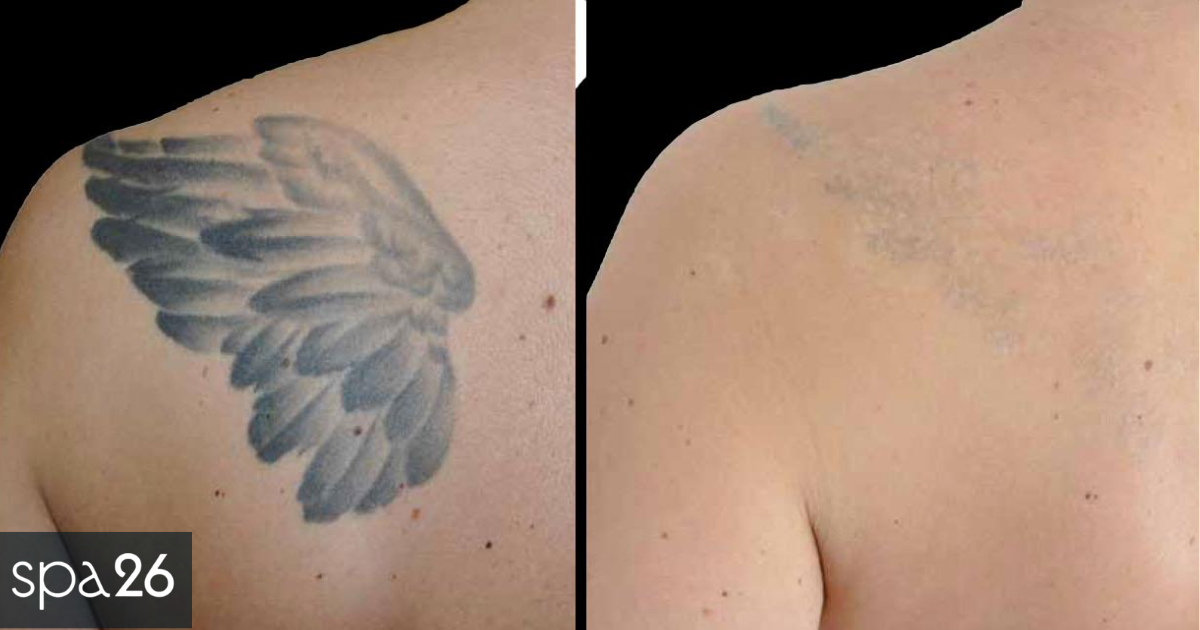 What Happens to the Skin During Laser Tattoo Removal?
