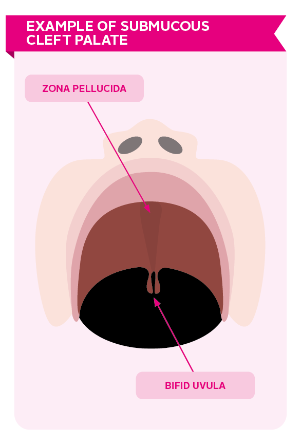 Image showing a representation of what a submucous cleft palate is