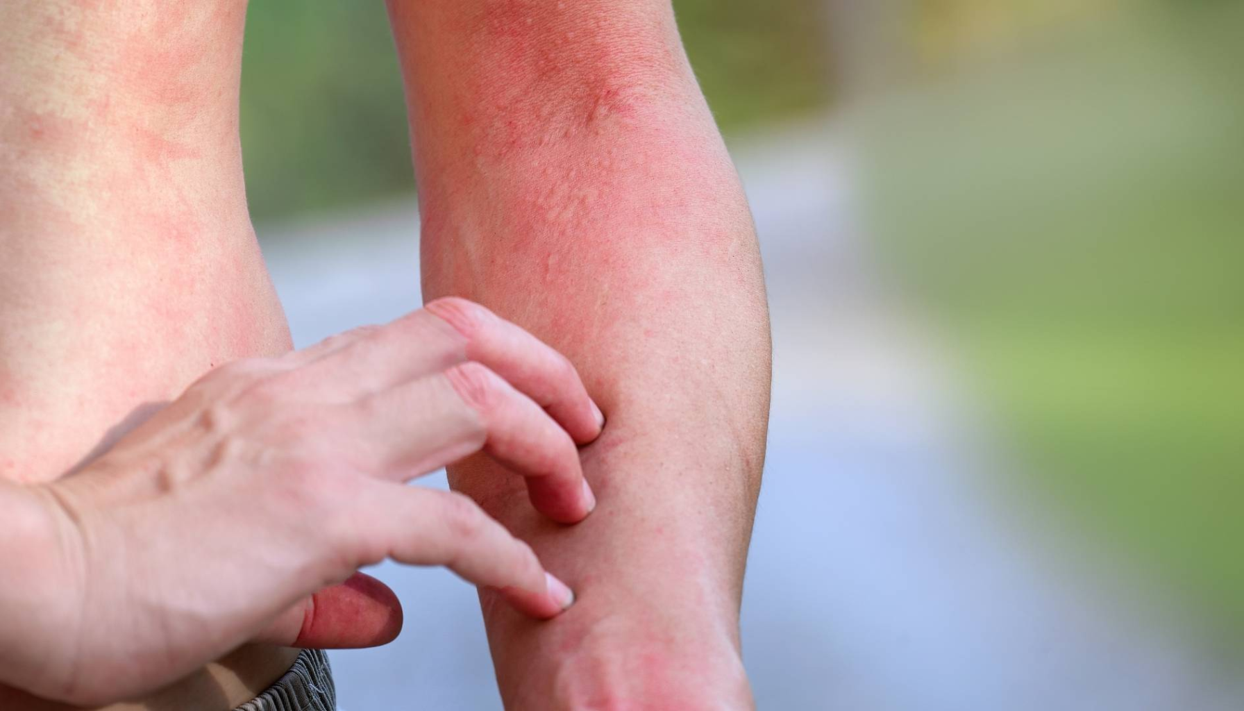 Candida: Den skjulte soppen i kroppen din 15 "Person klør på rød og irritert hud på armen.