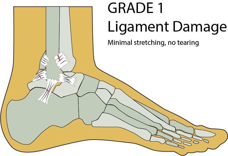 Image ligament damage grade 1