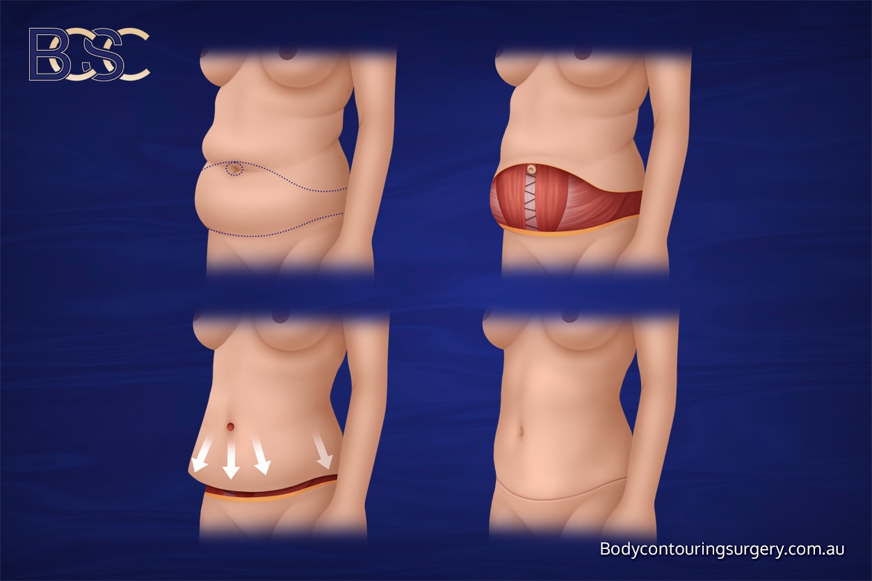 Extended abdominoplasty Extended abdominoplasty