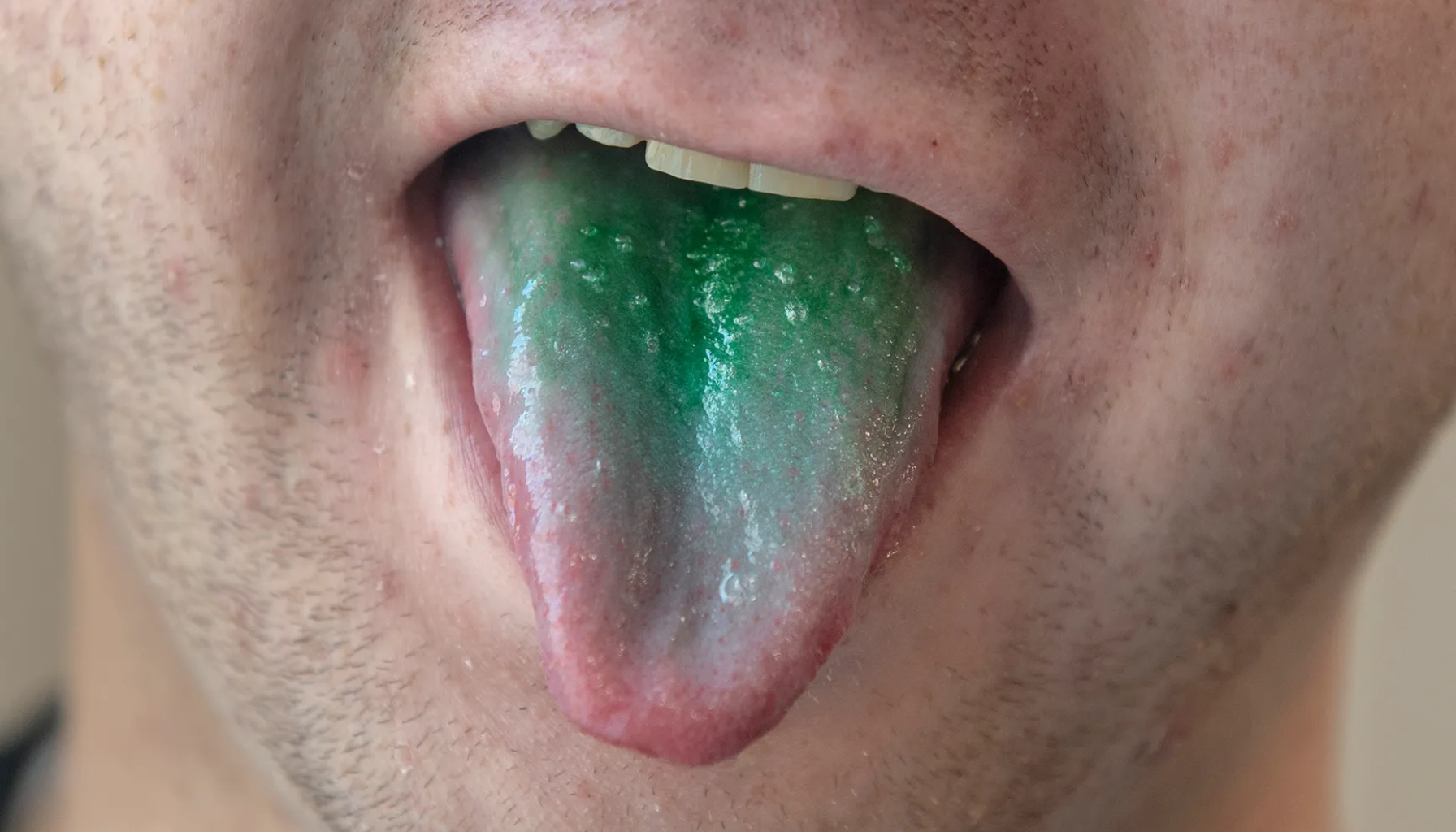 Grønn tunge – Hva det betyr og hvordan behandle det 17 Nærbilde av tunge med grønn misfarging og belegg som kan indikere infeksjon eller annen tilstand. grønn tunge hvitt belegg belegg på tunga dårlig munnhygiene røde flekker tungen sopp tunge munnen trøske belegg tunga behandling hos soppinfeksjon skyldes mer vanligvis sykdommer grønn sier ofte eksempel dårlig bør rød flekker oftest fått hårete antibiotika tegn hvite alkohol godt infeksjon røyking gul behandle legen finnes ganger blant andre små kreft lett personer publisert uker sår normalt hvit bakterier lege ser flere følge mye gjøre kommer tid hele enkelte hatt uvanlig mest alvorlige lenge brukte annen tidligere under samt gang