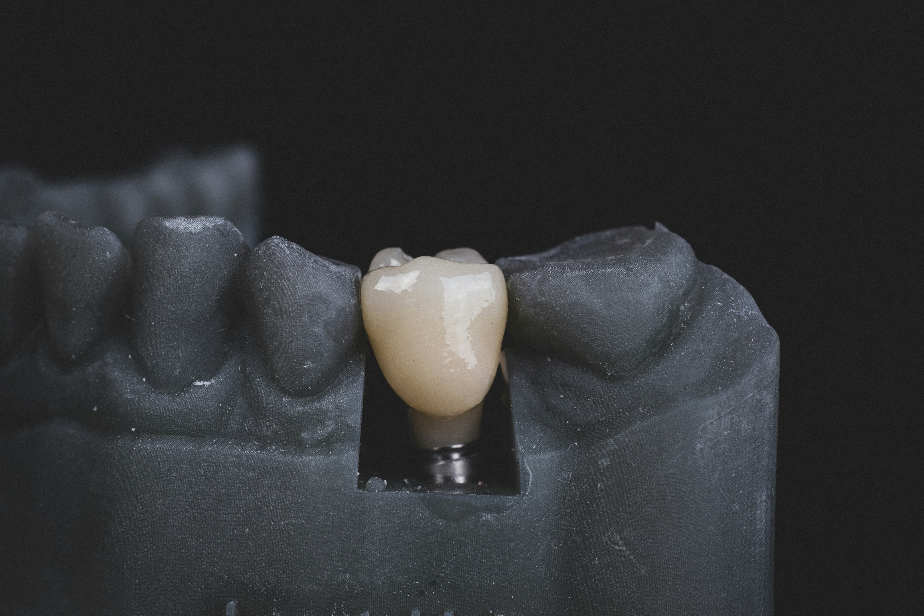 A dentist discussing dental implants as solutions for missing teeth.
