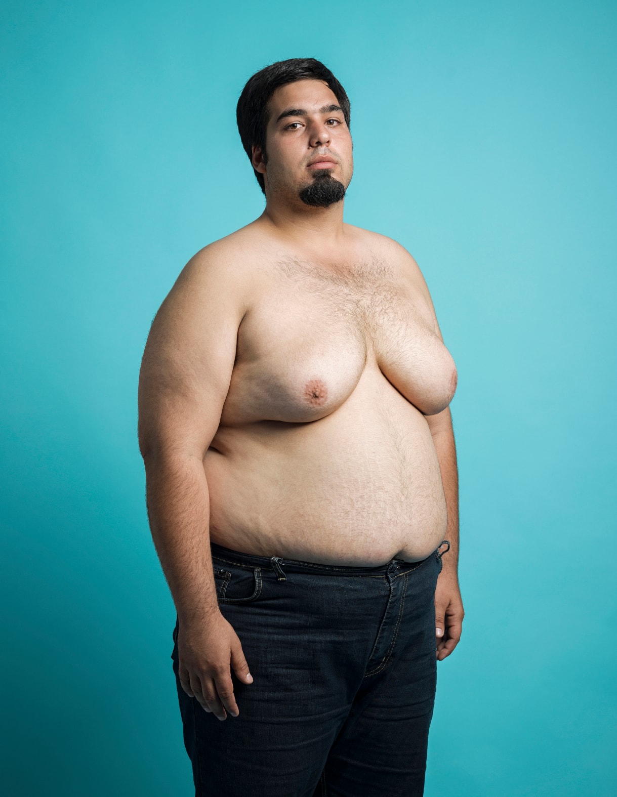 A over-weight male with gynecomastia