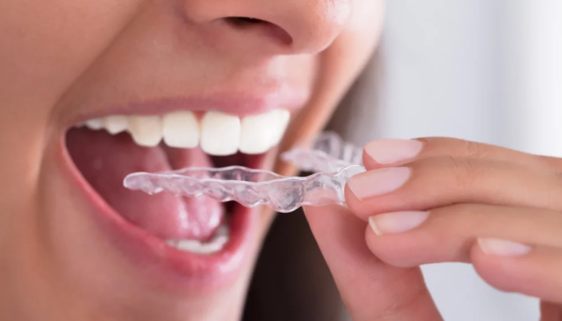 Kvinne setter inn en gjennomsiktig tannskinne i munnen for tannbeskyttelse eller tannregulering.
