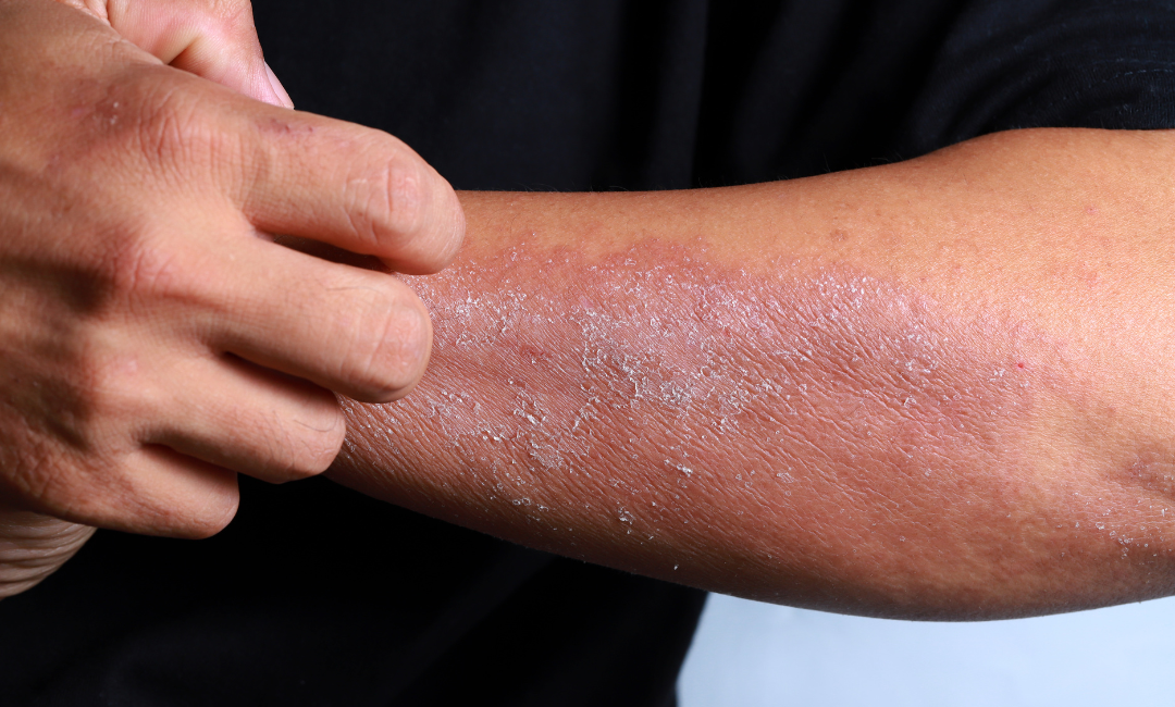 Is Eczema an Autoimmune Disease